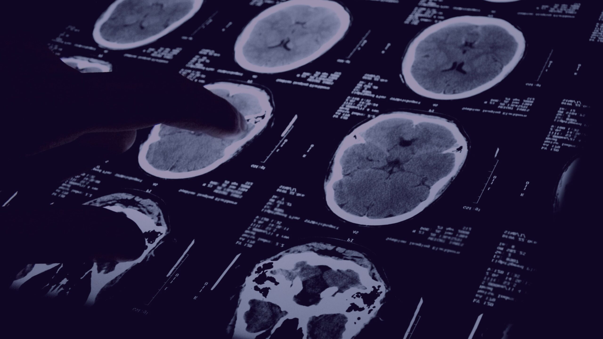 Intercranial scan Meningioma tumor